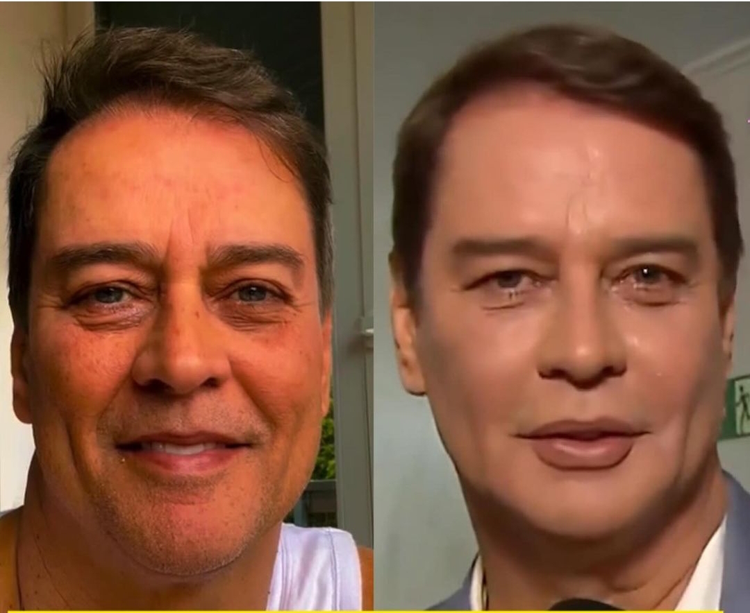 Marcello Antony antes e depois do procedimento estético