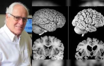 Médico brasileiro ganha prêmio internacional por pesquisas sobre Alzheimer