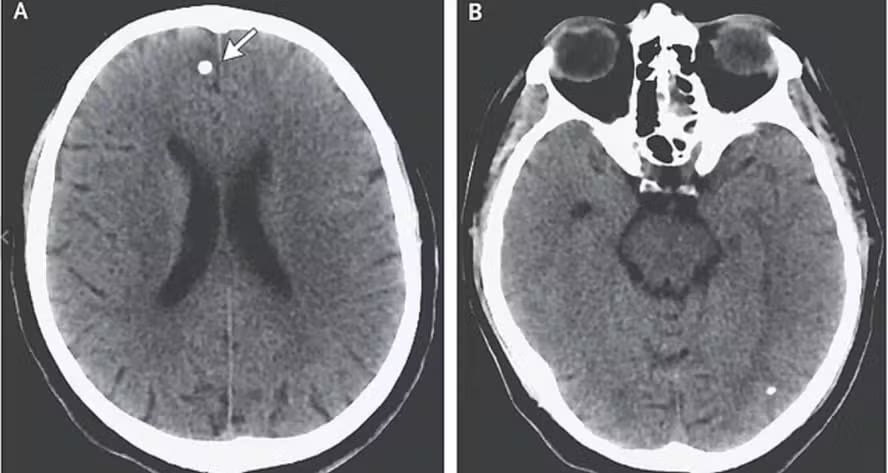 Quando chega ao cérebro (neurocisticercose), o paciente pode ter dores de cabeça frequentes, convulsões e confusão mental.