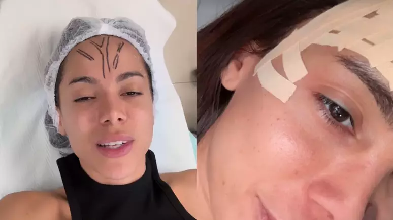 (Anitta passa por procedimento para retirar veia da testa.)