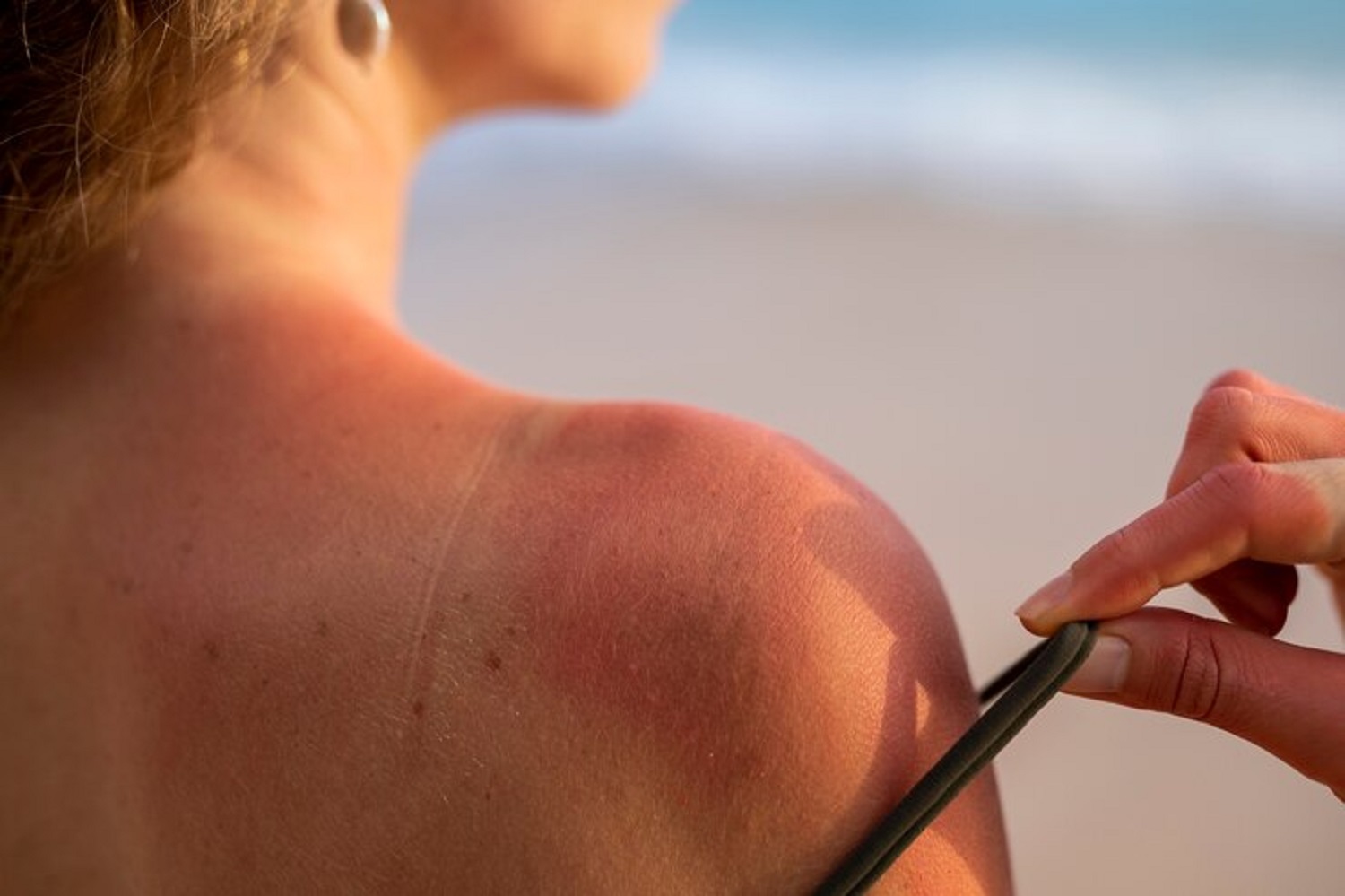 Dezembro Laranja: Tempo de duração de bronzeamento pode evitar câncer de pele