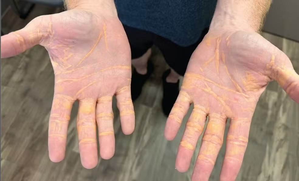 Ao tentarem entender como a situação tinha chegado a essas condições, o paciente contou estar há oito meses fazendo uma dieta carnívora.