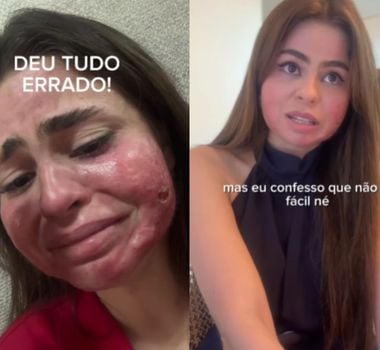 Imagem - Vídeo: médica tem lesões graves no rosto após peeling químico