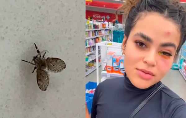 Imagem - Mosca de banheiro entra em olho de jovem e causa reação grave