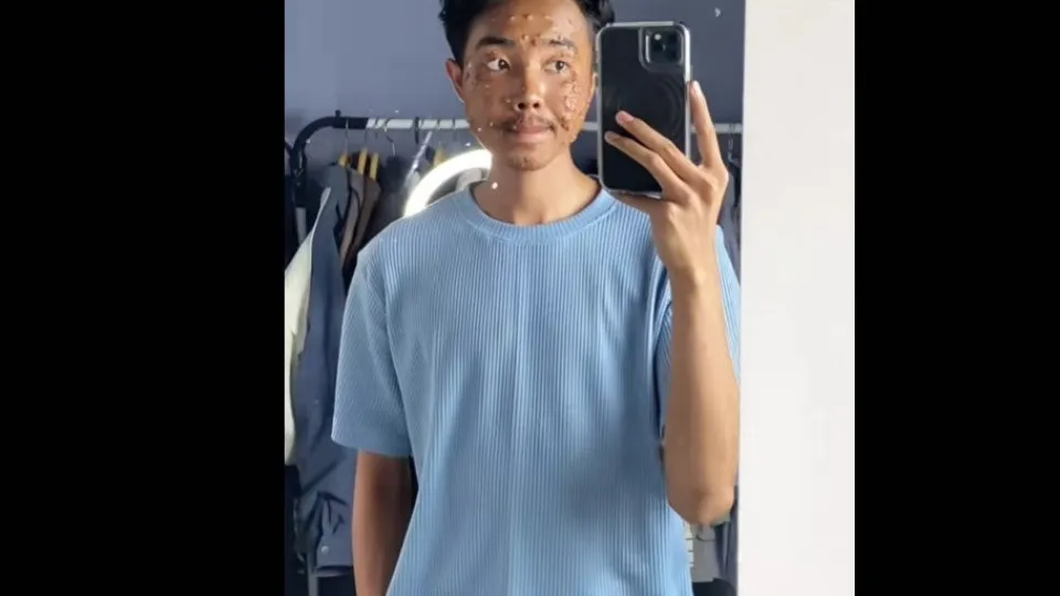 Homem contrai infecção viral após usar roupa de brechó sem lavar. 