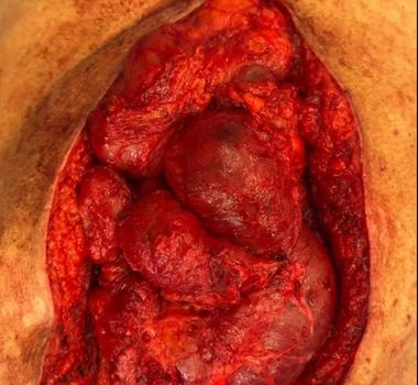 Imagem - Antes de deixar hospital, Bolsonaro publicou foto da barriga aberta com intestino a mostra