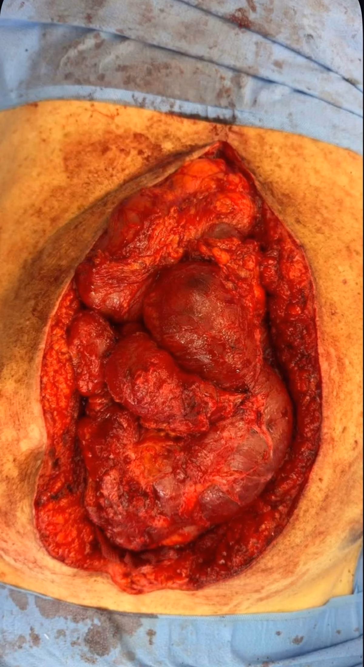 Foto da barriga aberta foi publicada nas redes sociais.