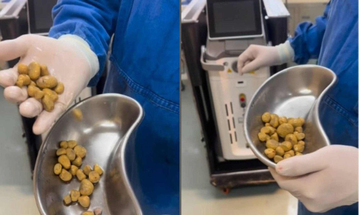 Imagem - Vídeo: médico retira 35 pedras de paciente que bebia três litros de refrigerante por dia