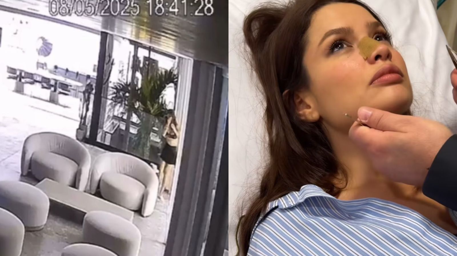 A cantora e ex-BBB Juliette Freire sofreu uma microfratura no nariz após  bater o rosto em uma porta de vidro em sua casa.