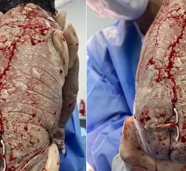 Imagem - Mãe engravida com DIU e bebê nasce com dispositivo colado no bumbum