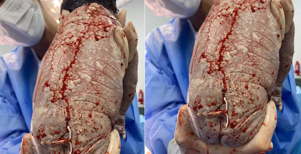 Imagem - Mãe engravida com DIU e bebê nasce com dispositivo colado no bumbum