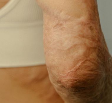 Imagem - Senado assegura cirurgia plástica reparadora para vítimas de queimaduras; confira