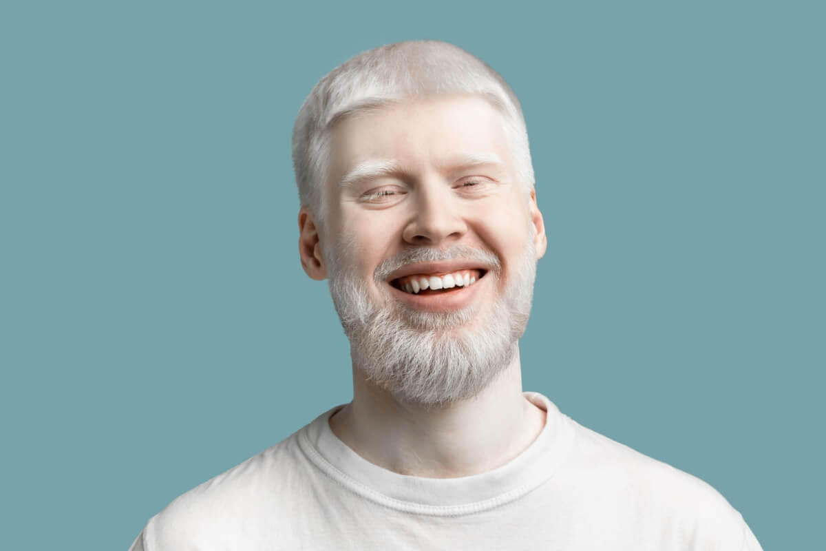  Dia Internacional de Conscientização sobre o Albinismo busca combater estigmas sociais sobre a condição (Imagem: Prostock-studio | Shutterstock) 