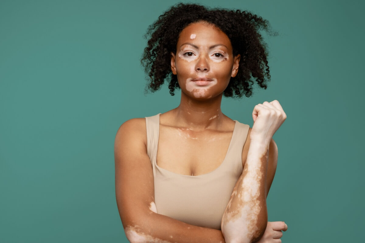 O vitiligo é uma doença autoimune que provoca a descoloração da pele (Imagem: Dean Drobot | Shutterstock)