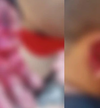 Imagem - Homem fica gravemente ferido após ataque de pitbull em Itaituba