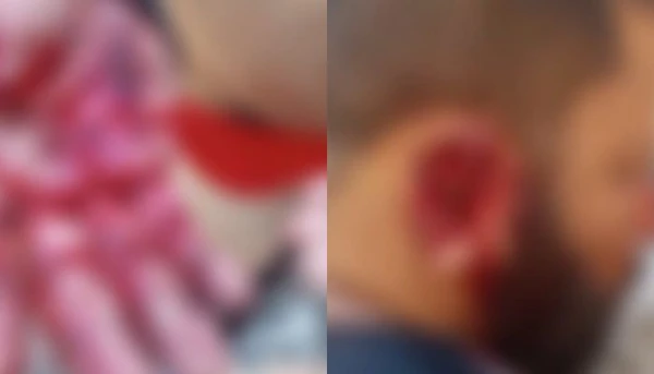 Homem fica gravemente ferido após ataque de pitbull em Itaituba