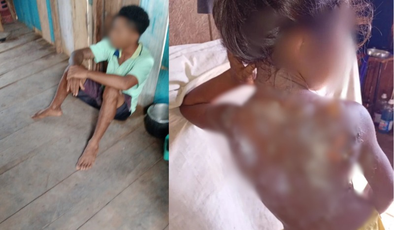 Um homem foi preso suspeito de jogar mingau quente no corpo da enteada, de 6 anos.