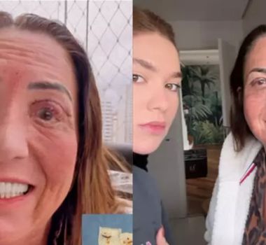 Imagem - Mãe de Virgínia passa por cirurgia ocular e influenciadora exibe pele retirada: 'nojo'