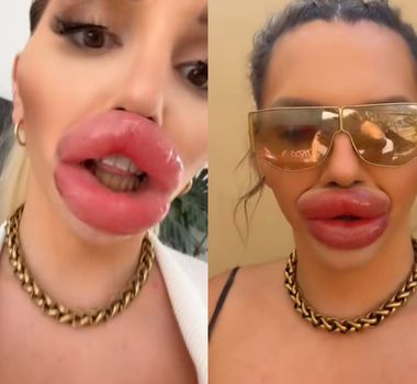 Imagem - Vídeo: excesso de preenchimento labial impede influenciadora de fechar a boca