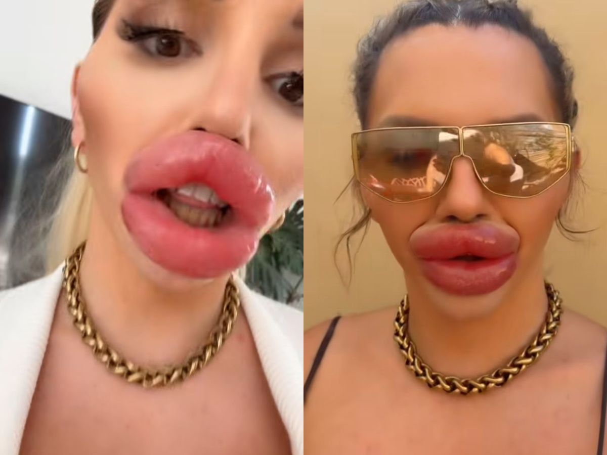 Influenciadora exagerou no preenchimento labial -
