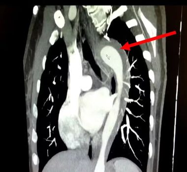 Imagem - Mulher rompe aorta após orgasmo e médicos explicam condição rara