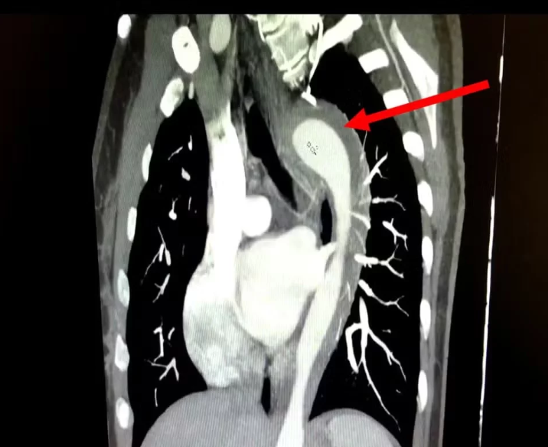 Imagem - Mulher rompe aorta após orgasmo e médicos explicam condição rara