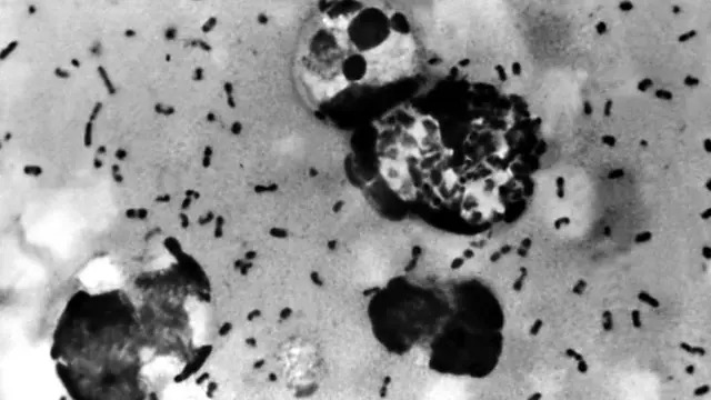Embora rara atualmente, a infecção pela Yersinia pestis ainda ocorre, principalmente em áreas rurais.