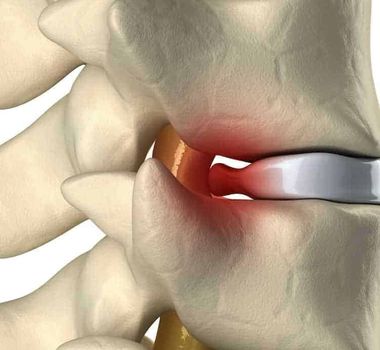 Imagem - Cirurgia de hérnia de disco: especialista desmistifica o procedimento