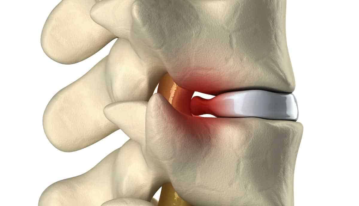 Cirurgia de hérnia de disco: especialista desmistifica o procedimento.