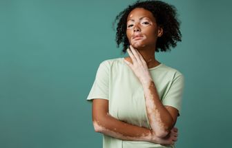 Conheça os principais sinais do vitiligo