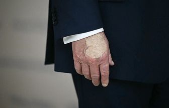 Trump volta a usar maquiagem na mão direita após diagnóstico de insuficiência venosa crônica