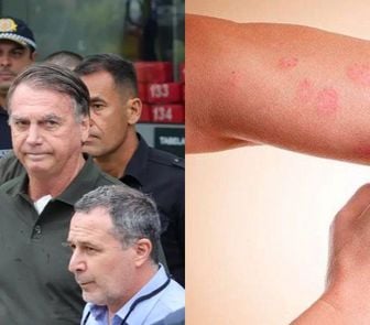 Imagem - Câncer de pele em Bolsonaro acende alerta: como identificar e tratar a doença
