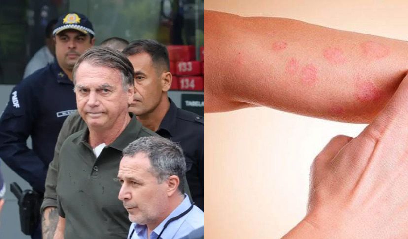 O laudo médico do ex-presidente Jair Bolsonaro (PL) confirmou, nesta quarta-feira (17), que ele retirou lesões de carcinoma,