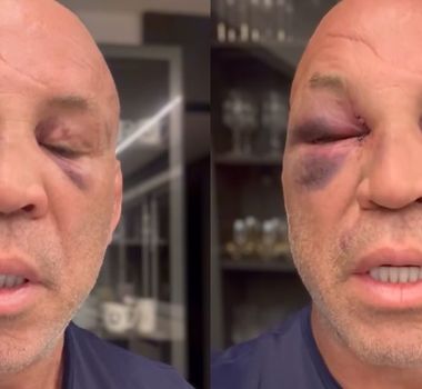 Imagem - Wanderlei exibe marcas de agressão e promete acionar Justiça
