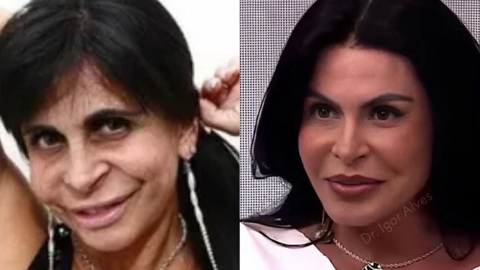 Gretchen mostra resultado de seu novo procedimento estético