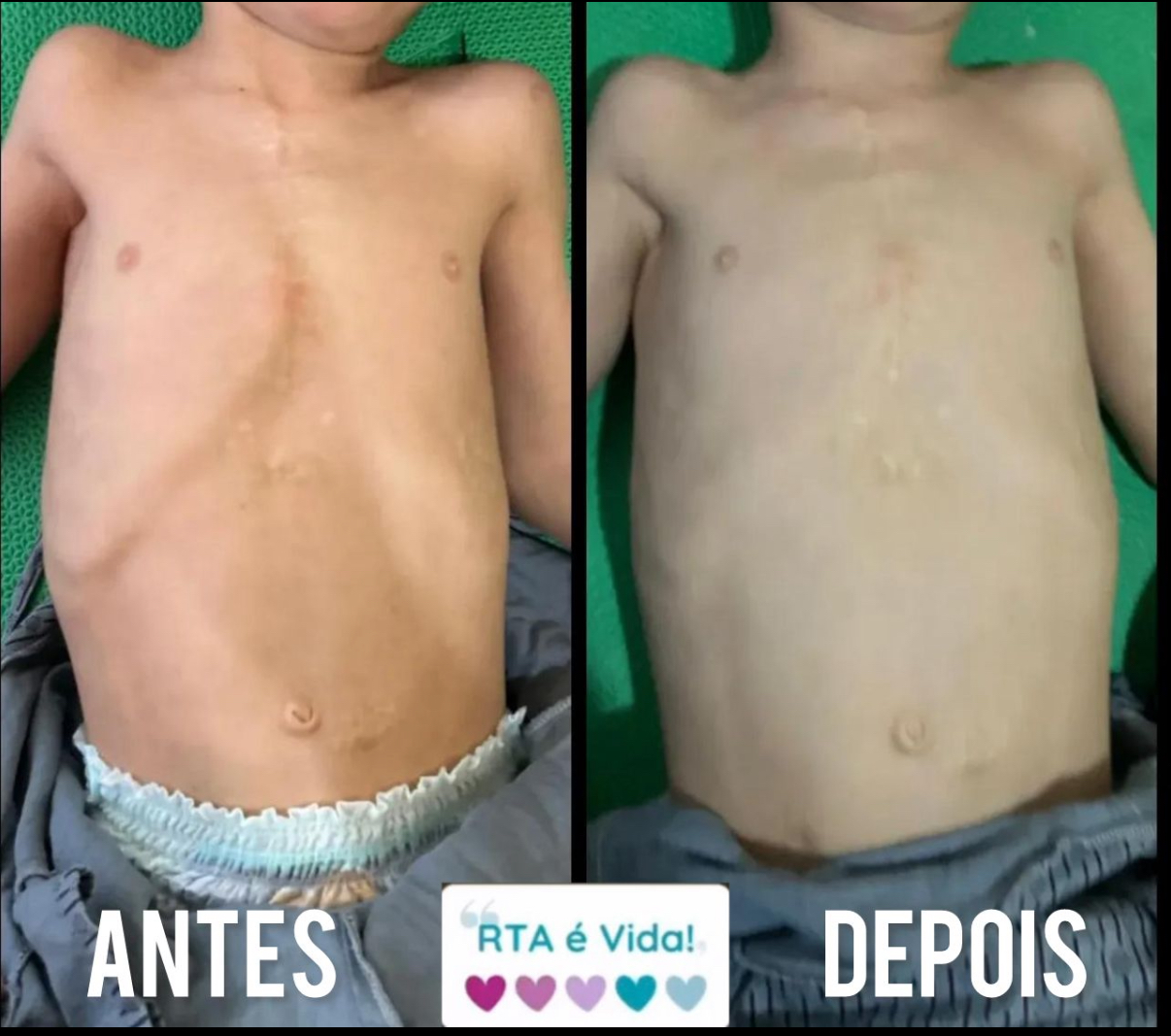 O antes e o depois do tratamento, utilizando o Método RTA, no desbloqueio da caixa torácica 