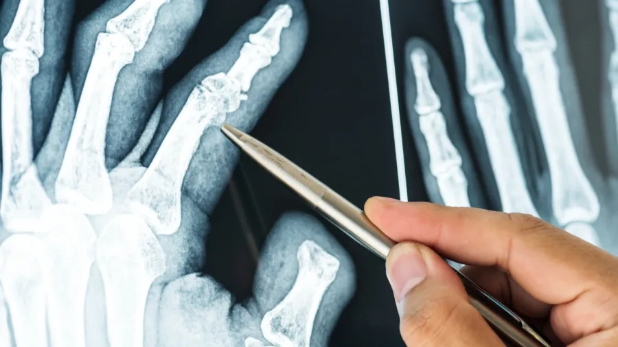 Imagem - Cola criada por chineses promete unir ossos quebrados em 3 minutos