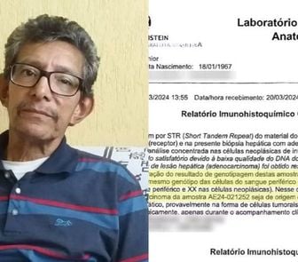 Imagem - Paciente do SUS descobre que fígado transplantado tinha câncer