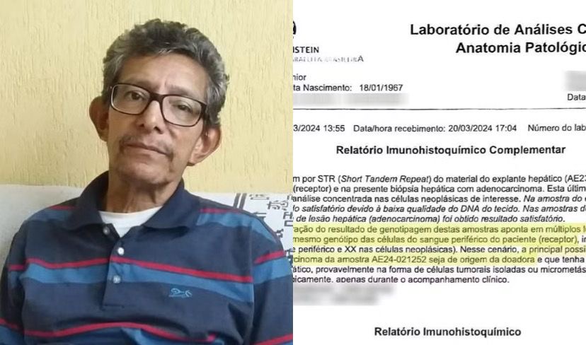 Homem de 58 anos foi diagnosticado com tumor meses após cirurgia feita no Hospital Albert Einstein; exames confirmaram que o câncer veio do órgão doado