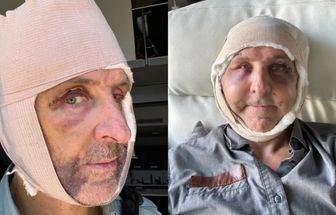 Homem injeta células das nádegas no rosto para viver mais