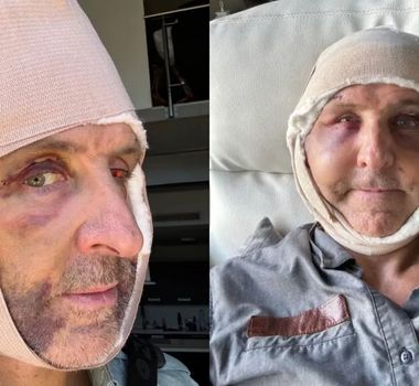 Imagem - Homem injeta células das nádegas no rosto para viver mais