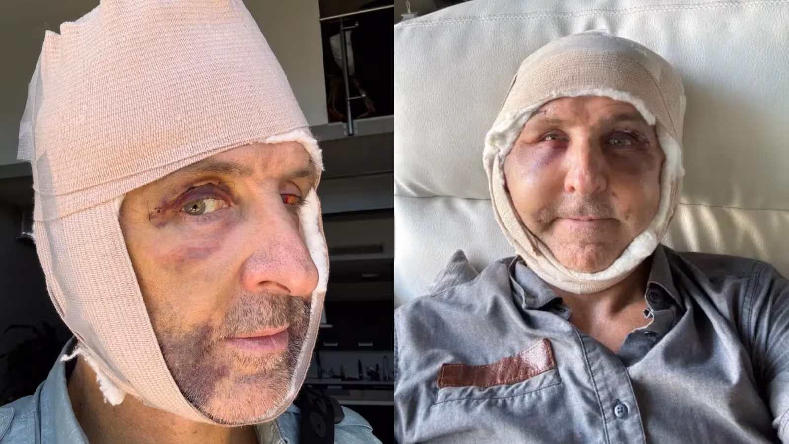 Imagem - Homem injeta células das nádegas no rosto para viver mais