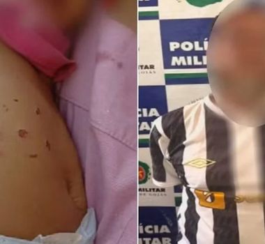 Imagem - Bebê de 10 meses é torturada e tem corpo marcado por queimaduras de cigarro