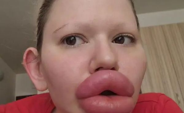 Mulher búlgara gasta R$ 140 mil por estética nos lábios