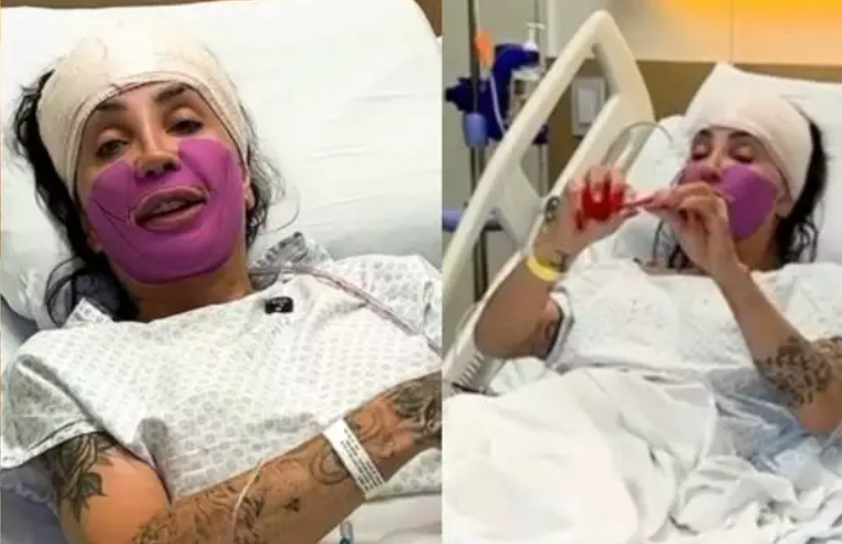 Influenciadora contou que enfrenta complicações após procedimento estético e mudou a medicação sob orientação médica para tentar conter o quadro