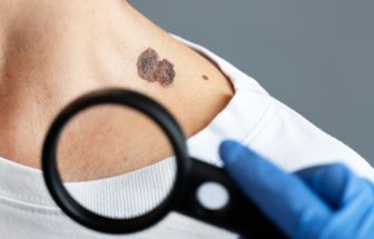 Dezembro Laranja: sinais quase invisíveis que podem indicar câncer de pele e como identificá-los a tempo