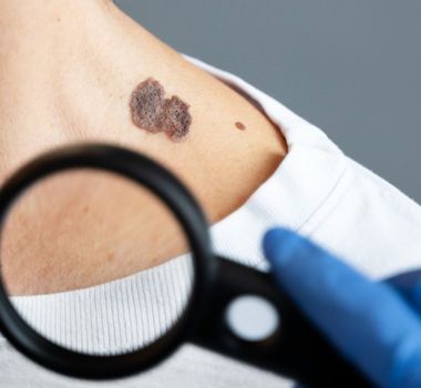 Imagem - Dezembro Laranja: sinais quase invisíveis que podem indicar câncer de pele e como identificá-los a tempo