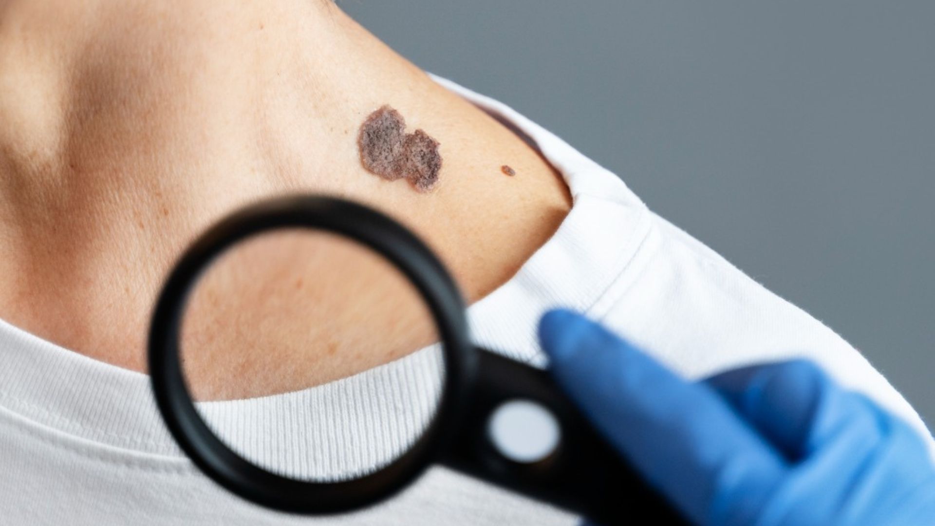 Dezembro Laranja, campanha nacional de prevenção ao câncer de pele.