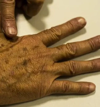 Imagem - Dezembro Laranja: campanha reforça alerta sobre prevenção do câncer de pele com atendimento gratuito neste sábado (13)