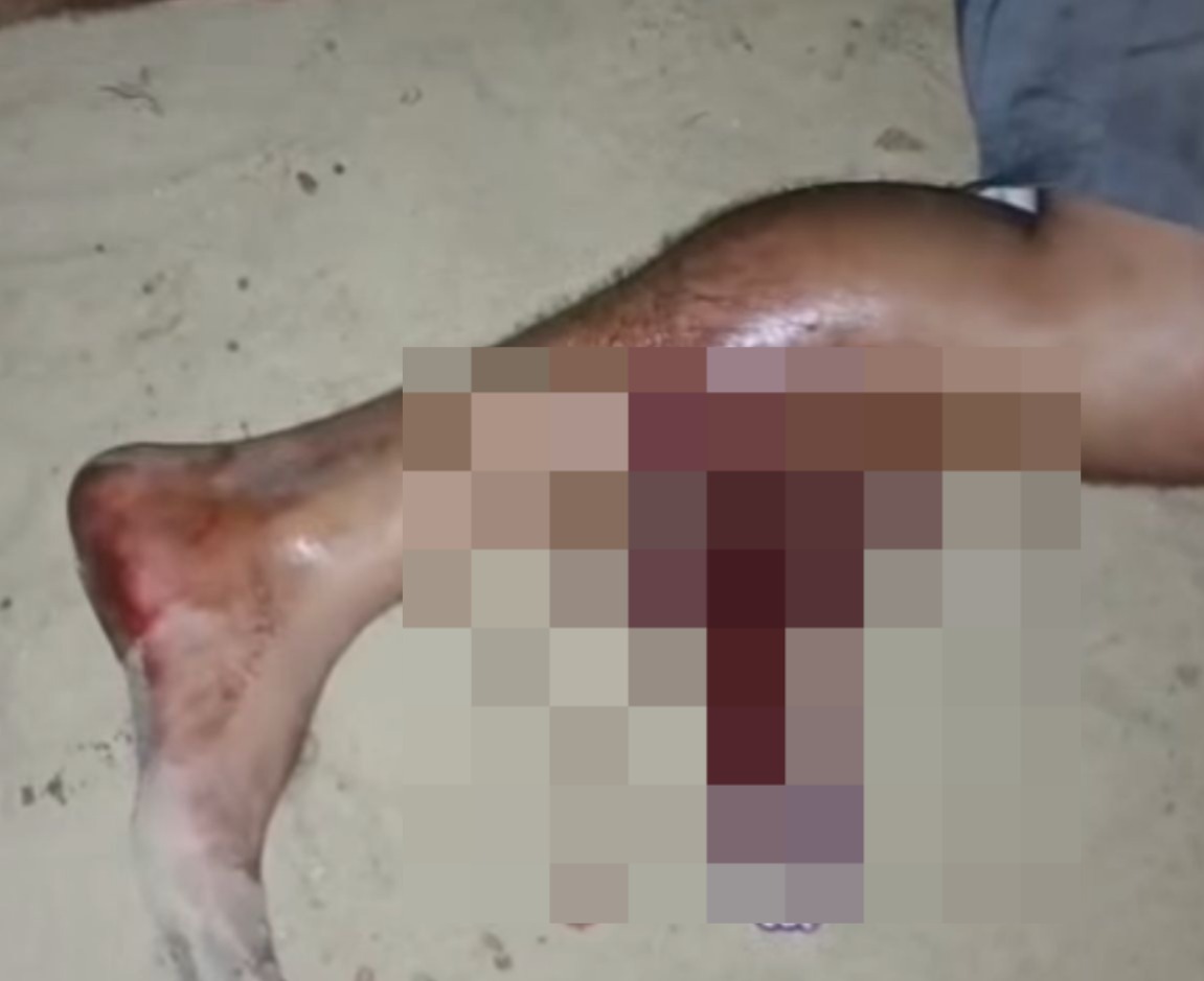 Homem foi atingido com tiros na perna - 